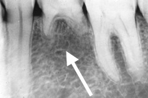 Hypodontia 3.5 missing PA UM.jpg